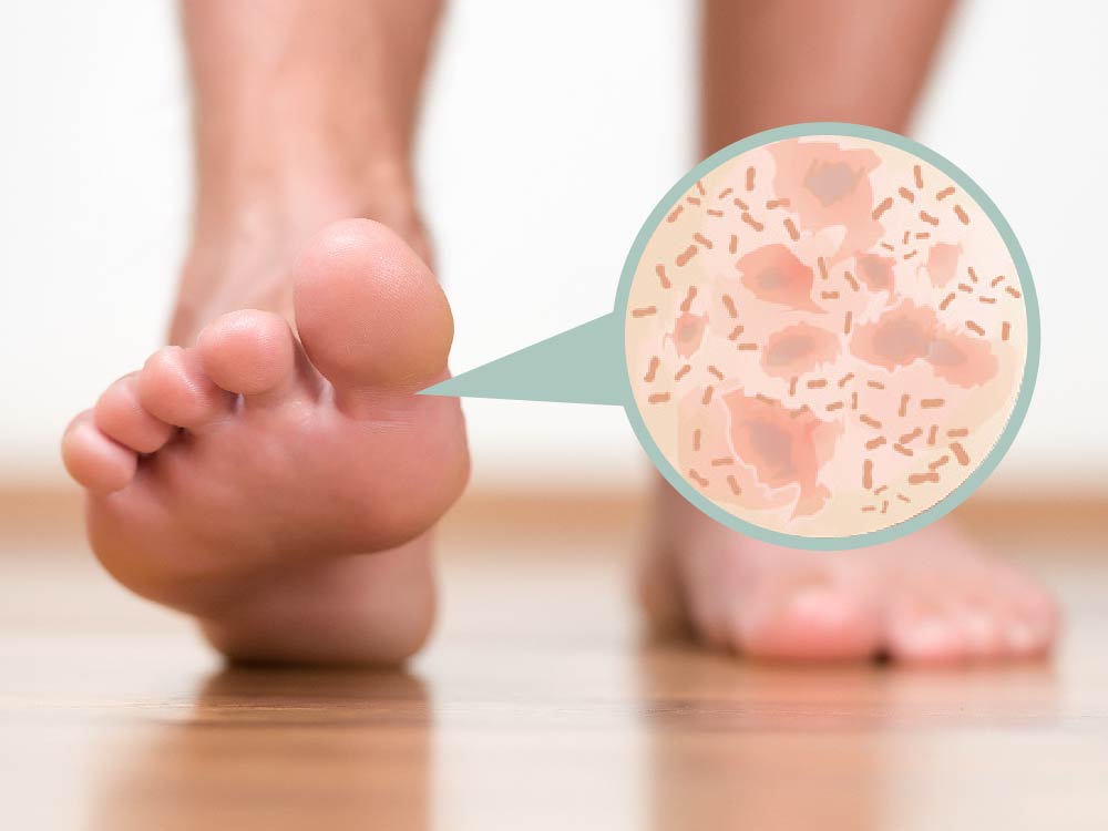 Ursachen von Fußgeruch durch Bakterien