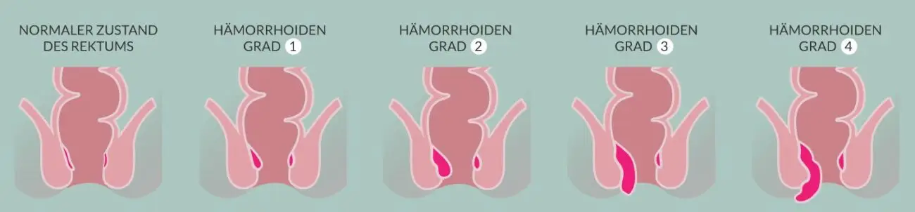 Die 4 Hämorrhoiden-Grade