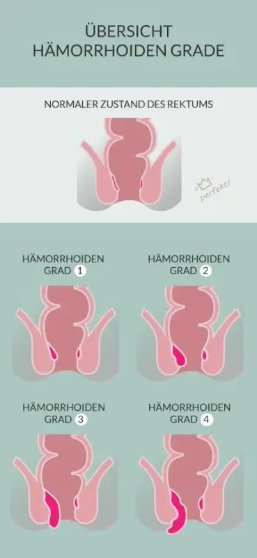 Die 4 Hämorrhoiden-Grade