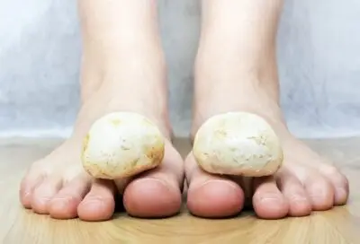 Tipps gegen Fußpilz für gesunde Füße