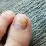 Nagelpilz Nahaufnahme