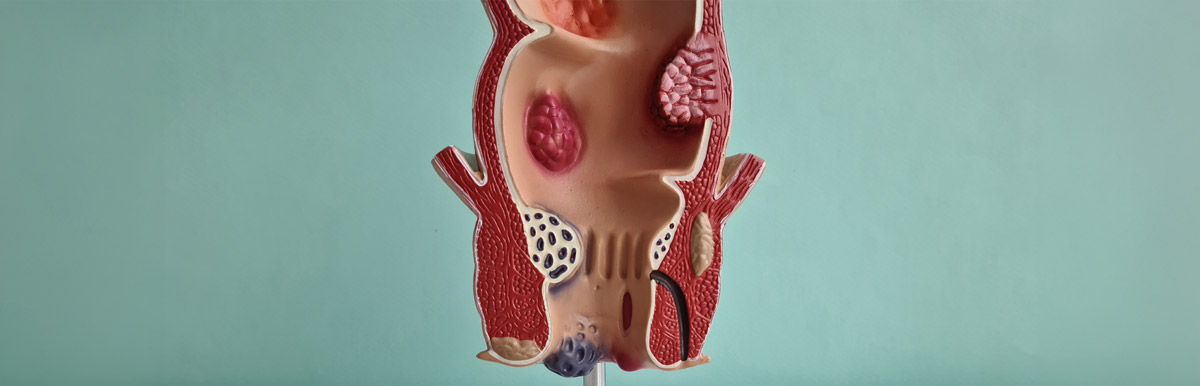 Analfistel erkennen & behandeln