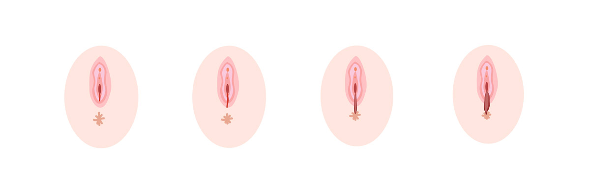 Dammriss illustriert
