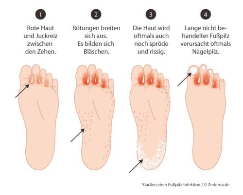 Fußpilz Zwischen Den Zehen Was Tun www.heynature.de